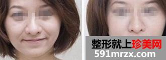 　填充法令纹价格曝光一览  