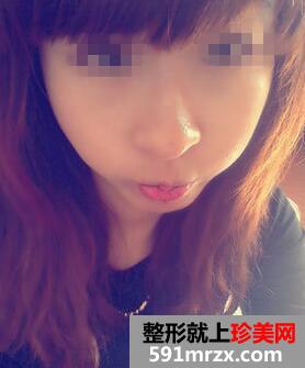 复合彩光祛斑9天 终于不是＂小麻雀＂啦