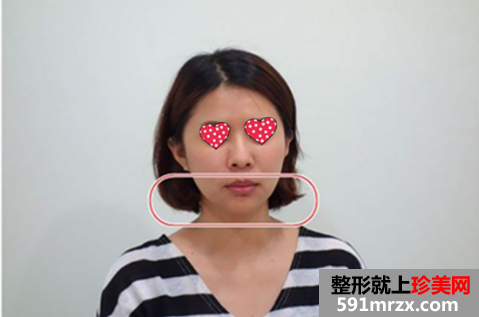 郑州梨花雨整形医院音波拉皮 宝妈不服老