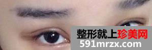 埋线法双眼皮
