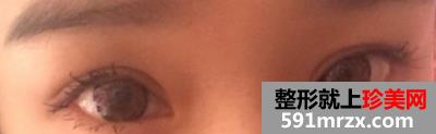 埋线法双眼皮