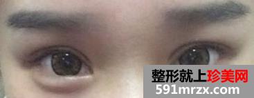 埋线法双眼皮