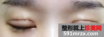 埋线法双眼皮