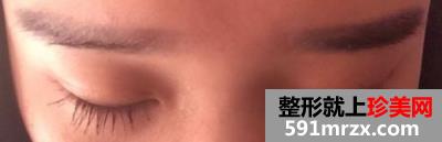 埋线法双眼皮