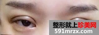 埋线法双眼皮