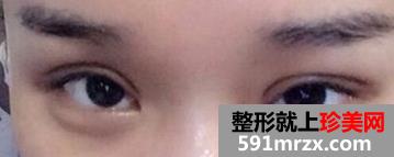 埋线法双眼皮