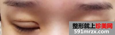 埋线法双眼皮