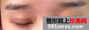 埋线法双眼皮