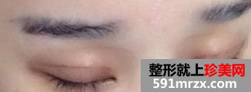 埋线法双眼皮