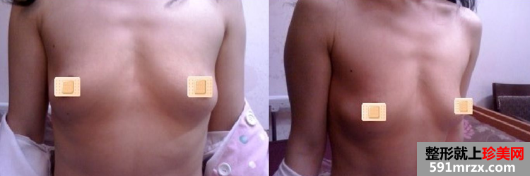 假体丰胸手术恢复全过程 看37岁的妈妈如何逆袭成少女