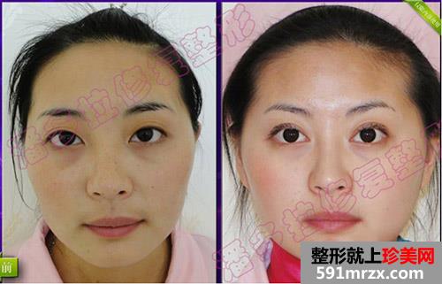 合肥韩美整形医院面部整形精心塑美 我是这样变得人见人爱