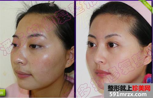 合肥韩美整形医院面部整形精心塑美 我是这样变得人见人爱