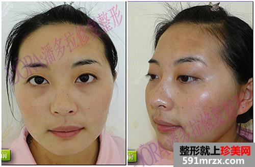 合肥韩美整形医院面部整形精心塑美 我是这样变得人见人爱