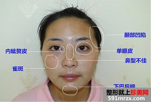 合肥韩美整形医院面部整形精心塑美 我是这样变得人见人爱
