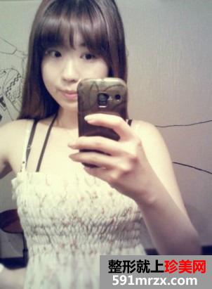 埋线,双眼皮,韩式,开内眼角,手术,恢复,过程,前后,对比,效果图