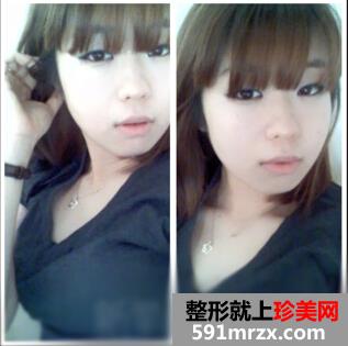 埋线,双眼皮,韩式,开内眼角,手术,恢复,过程,前后,对比,效果图