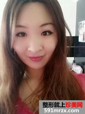 割双眼皮,手术,恢复,过程,前后,对比,效果,图片