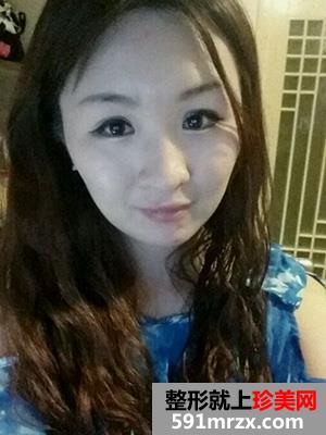 割双眼皮,手术,恢复,过程,前后,对比,效果,图片