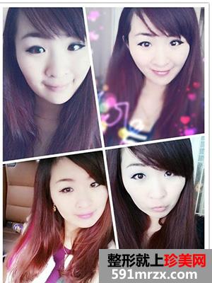 割双眼皮,手术,恢复,过程,前后,对比,效果,图片