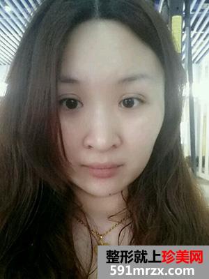 割双眼皮,手术,恢复,过程,前后,对比,效果,图片