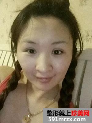 割双眼皮,手术,恢复,过程,前后,对比,效果,图片