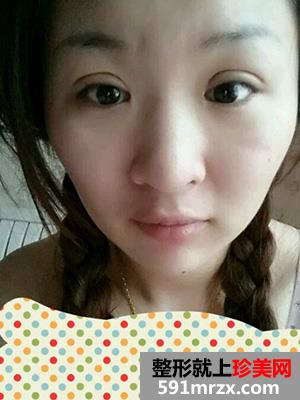 割双眼皮,手术,恢复,过程,前后,对比,效果,图片