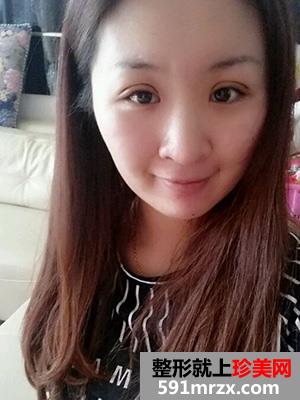 割双眼皮,手术,恢复,过程,前后,对比,效果,图片