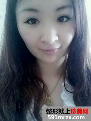 割双眼皮,手术,恢复,过程,前后,对比,效果,图片