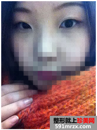 韩式无痕开眼角手术恢复过程及前后效果对比照片