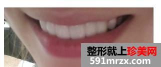 宁波美莱整形医院美容冠 我爱死现在的牙齿了