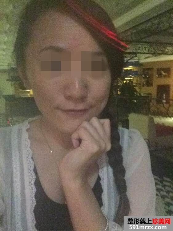 【内窥镜除皱去鱼尾纹前后对比效果图片和恢复过程】