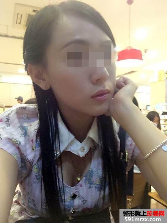 【内窥镜除皱去鱼尾纹前后对比效果图片和恢复过程】
