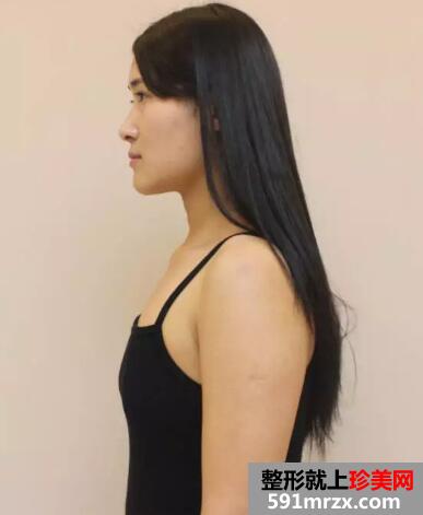 郑州90后瑜伽老师无痕丰胸手术一周后做了什么