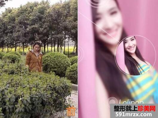 郑州90后瑜伽老师无痕丰胸手术一周后做了什么