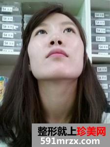 上海,仁爱,医院,刘庆阳,下颌角,磨削,多少钱,好不好,案例