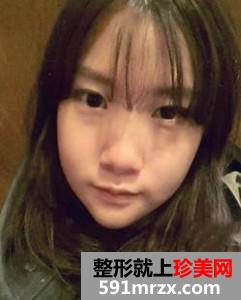 上海,仁爱,医院,刘庆阳,下颌角,磨削,多少钱,好不好,案例