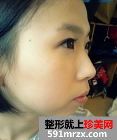 硅胶假体隆鼻+自体脂肪丰额头 驾驭各种发型