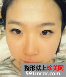 硅胶假体隆鼻+自体脂肪丰额头 驾驭各种发型