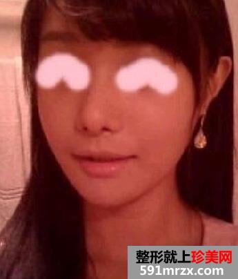 颧骨,颧弓,整形,手术,恢复,过程,前后,对比,效果图,分享
