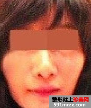 颧骨,颧弓,整形,手术,恢复,过程,前后,对比,效果图,分享