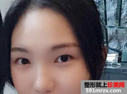 微创韩式双眼皮手术真实案例分享和前后对比照