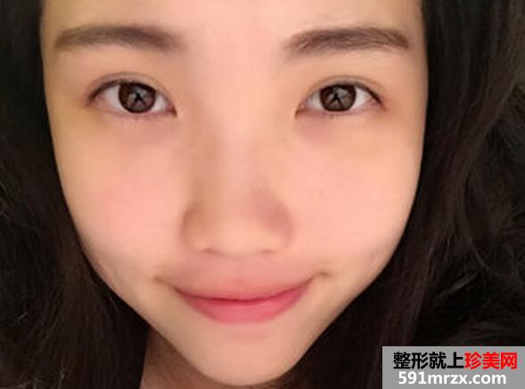 微创韩式双眼皮手术真实案例分享和前后对比照