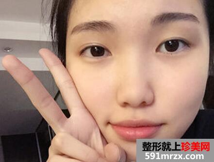 微创韩式双眼皮手术真实案例分享和前后对比照