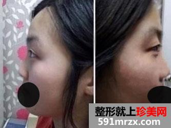 做双眼皮和隆鼻手术已经快三个月了 快来围观啊