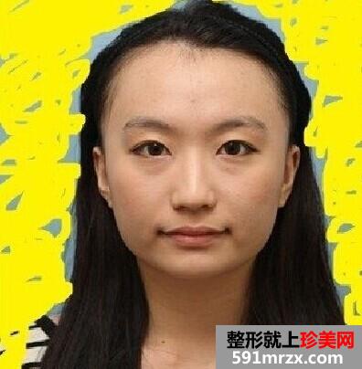 上海,九院,颧骨,整形,零,失败,案例,国字脸,再见