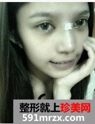 韩式纳米仿真隆鼻术+韩式无痕开眼角 大家说我像混血儿