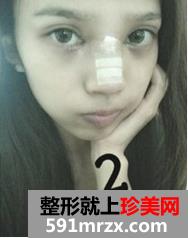 韩式纳米仿真隆鼻术+韩式无痕开眼角 大家说我像混血儿