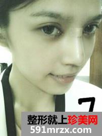 韩式纳米仿真隆鼻术+韩式无痕开眼角 大家说我像混血儿