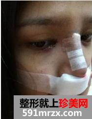 韩式纳米仿真隆鼻术+韩式无痕开眼角 大家说我像混血儿
