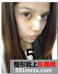 韩式纳米仿真隆鼻术+韩式无痕开眼角 大家说我像混血儿